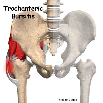 Trochanteric bursitis: Causes and treatment of hip bursitis