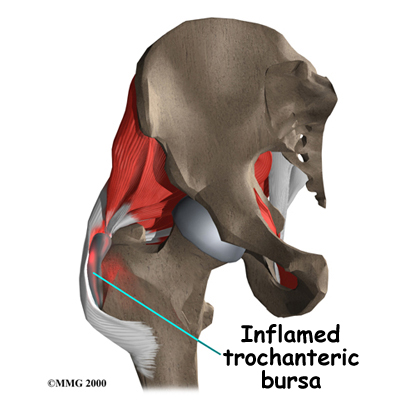 Physical Therapy in Northern Virginia for Trochanteric Bursitis of the Hip