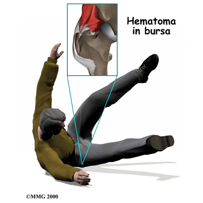 Physical Therapy in Northern Virginia for Trochanteric Bursitis of the Hip