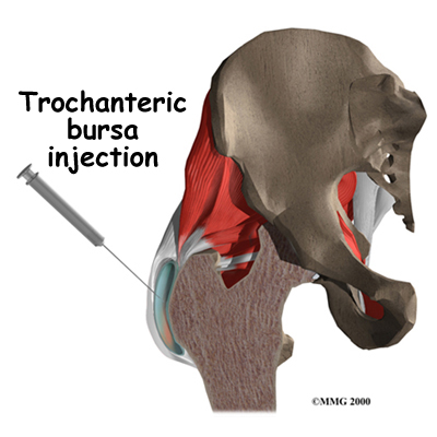 What Does Bursitis in the Hip Feel Like?