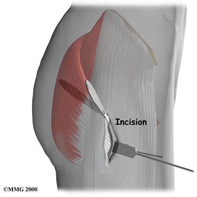 Physical Therapy in Northern Virginia for Trochanteric Bursitis of the Hip