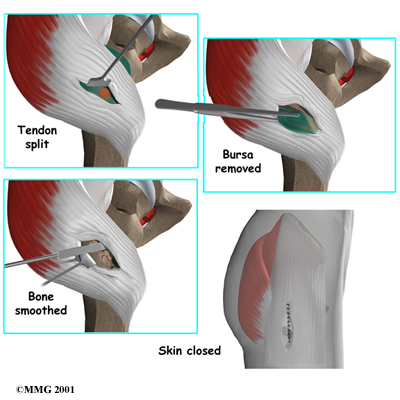 Hip Bursitis / Tendonitis — Empower