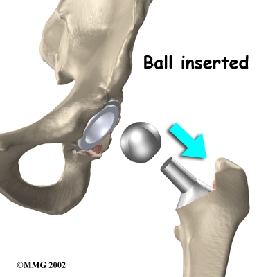 Solved The Newest Replacement Parts For Artificial Hip, 45% OFF