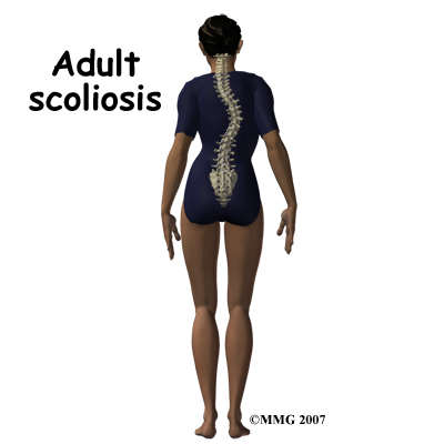 Physical Therapy in Northern Virginia for Lower Back Pain - Scoliosis