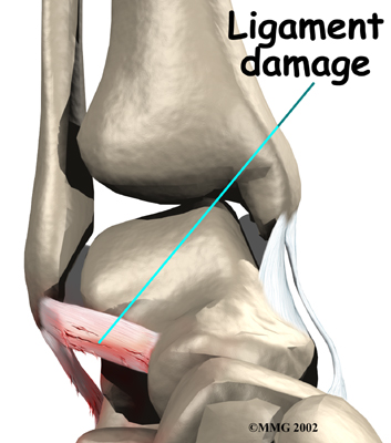 Coronary Ligament Sprain - Symptoms, Causes, Treatment