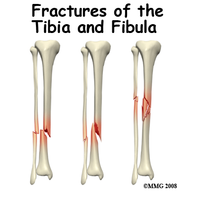 Broken Leg: If my tibial shaft fracture gets surgery, when can I