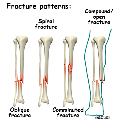 Spiral Fracture: Healing Time, Tibia, and Fibula