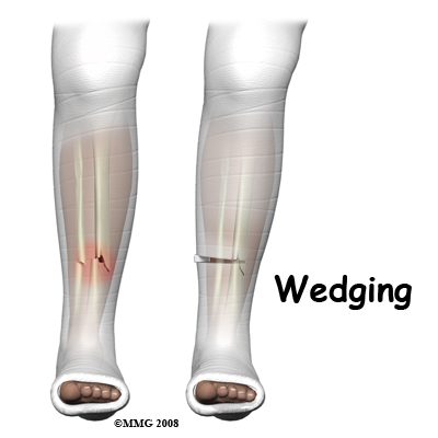 Spiral Fracture: Healing Time, Tibia, and Fibula