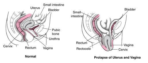 Urethra Defects - Children's Health Issues - Merck Manuals