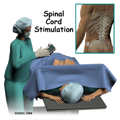 Is Spinal Cord Stimulation the Answer to Your Chronic Back Pain