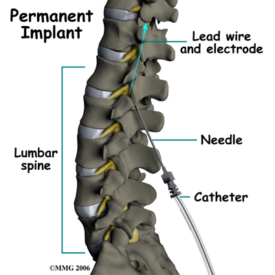 What Does A Spinal Cord Stimulator Do? - Nebraska Spine Hospital