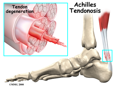 Red flags and tests for Achilles tendon ruptures and tears