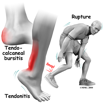 Physical Therapy Achilles