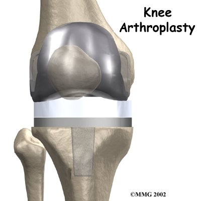 knee joint replacement devices
