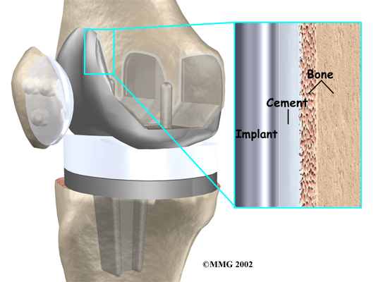 knee joint replacement devices